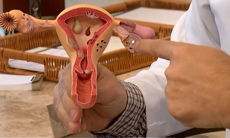 Aberta chamada pública para pesquisas sobre endometriose