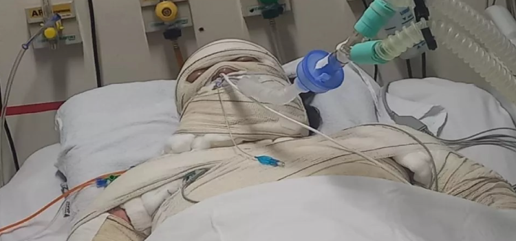 CASCAVEL: Mulher que teve 70% do corpo queimado aguarda vaga em hospital especializado.