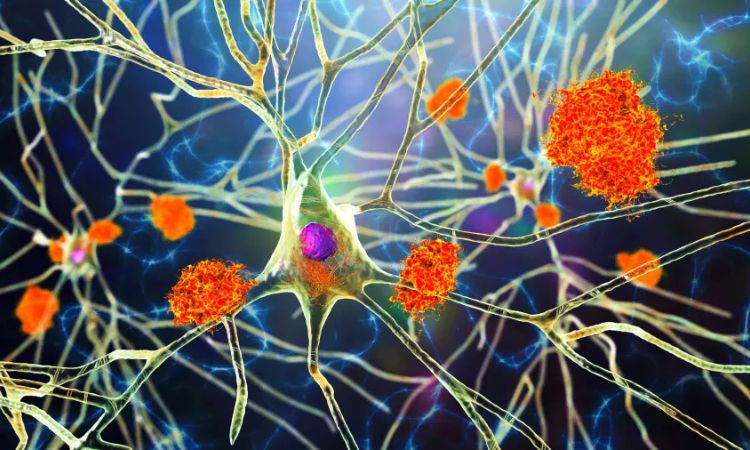 Novo tratamento para Alzheimer com Donanemabe começa a ser usado no Brasil